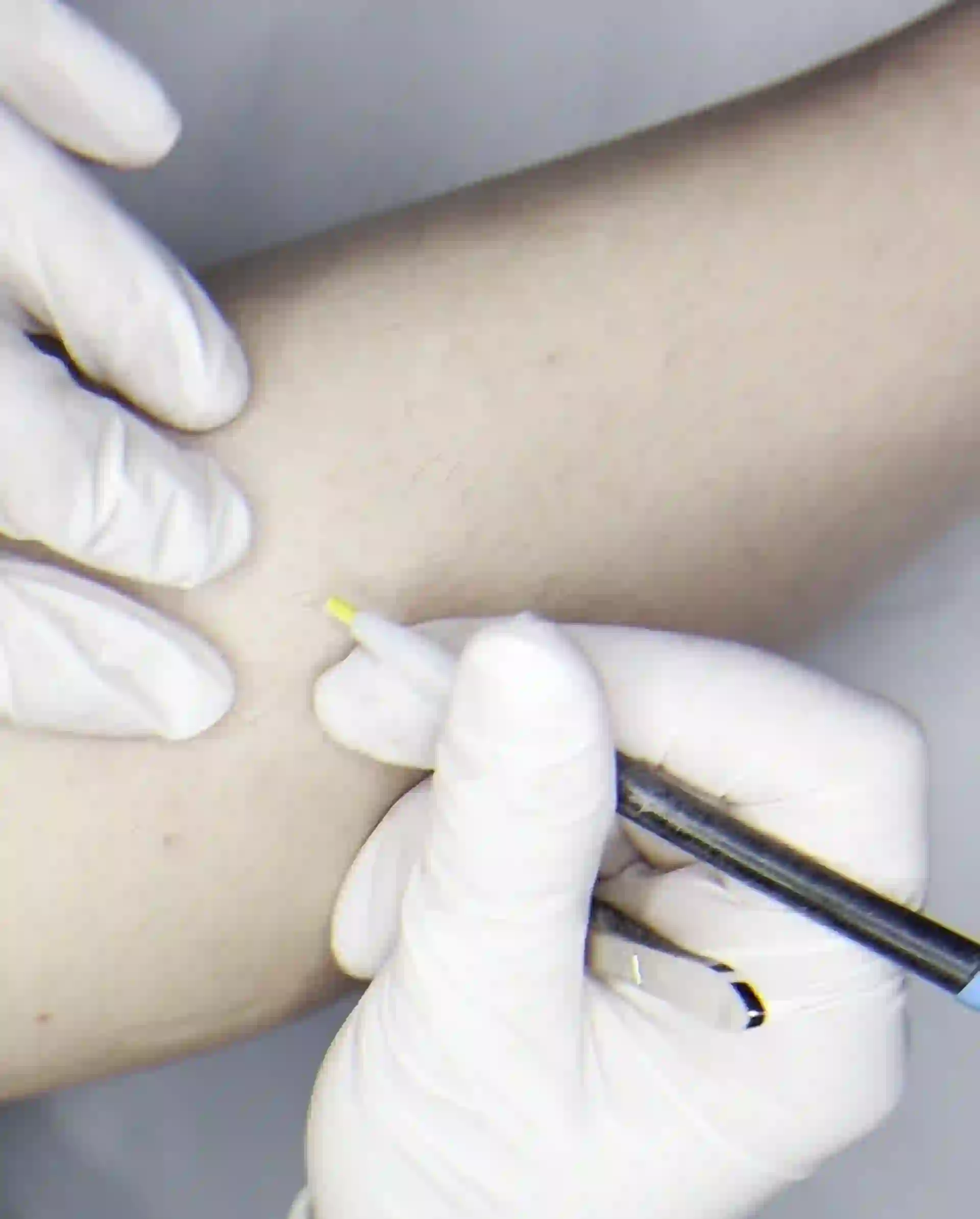 Séance d'électrolyse par haute fréquence chez Fée la belle by Anaïs